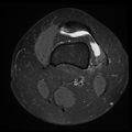 Anterior cruciate ligament tear, Wrisberg rip and bucket-handle tear of medial meniscus (Radiopaedia 75872-87266 Axial PD fat sat 25).jpg