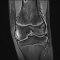 Anterior cruciate ligament tear - pediatric (Radiopaedia 62152-70260 Coronal PD fat sat 12).jpg