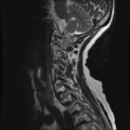 Anterior spinal artery syndrome (Radiopaedia 46335-50750 A 2).png
