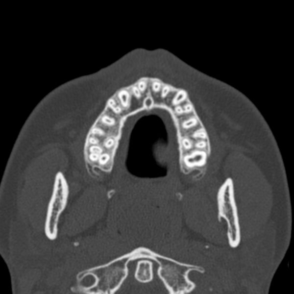File:Antrochoanal polyp (Radiopaedia 21894-21868 Axial bone window 6).jpg