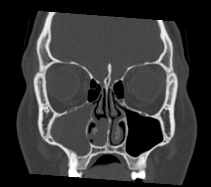 File:Antrochoanal polyp (Radiopaedia 21894-21868 Coronal bone window 11).jpg