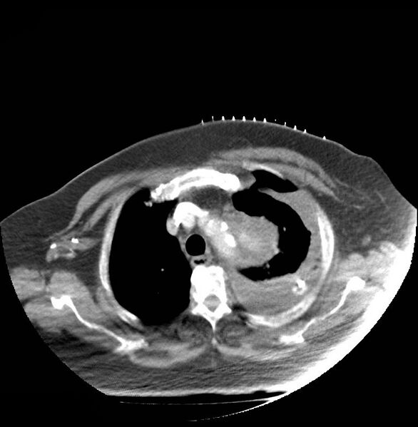 File:Aortic arch false aneurysm (Radiopaedia 14667-14588 A 3).jpg