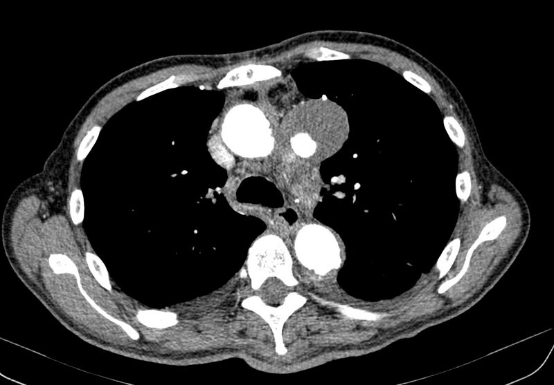 File:Aortic arch saccular aneurysm (Radiopaedia 19430-19457 B 8).jpg