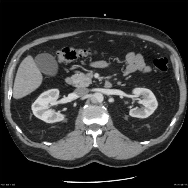 File:Aortic dissection- Stanford A (Radiopaedia 37759-39664 A 92).jpg
