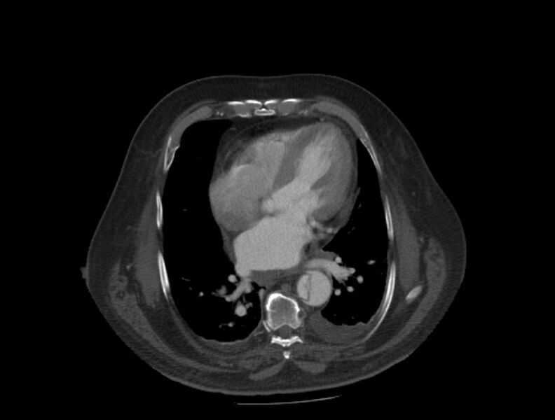 File:Aortic dissection (Radiopaedia 28802-29105 A 25).jpg