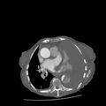 Aortic dissection (Radiopaedia 68763-78691 A 29).jpeg