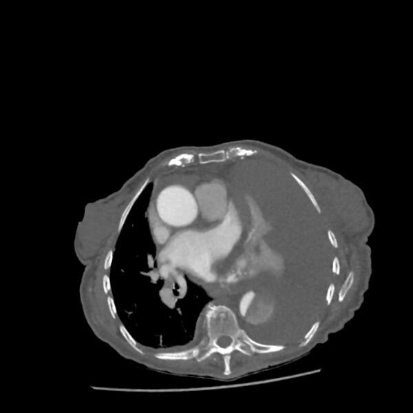 File:Aortic dissection (Radiopaedia 68763-78691 A 29).jpeg