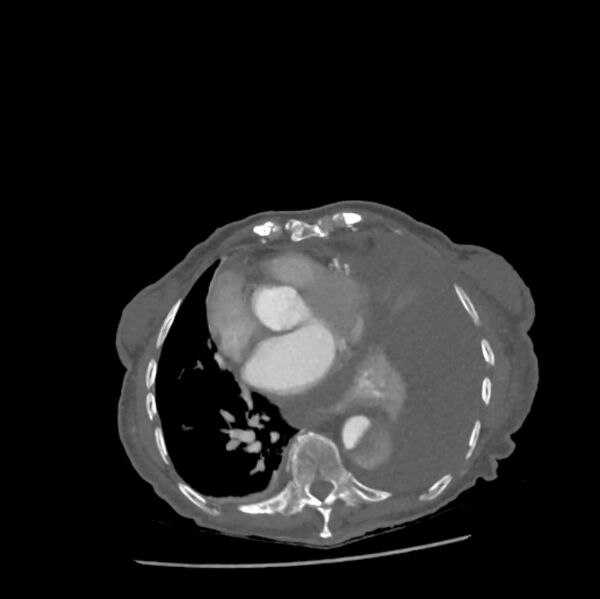 File:Aortic dissection (Radiopaedia 68763-78691 A 35).jpeg