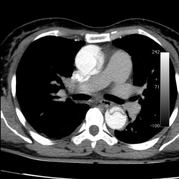 File:Aortic dissection - Stanford type A (Radiopaedia 29247-29659 A 34).jpg