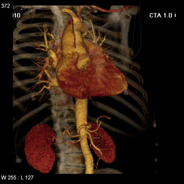 File:Aortic dissection with rupture into pericardium (Radiopaedia 12384-12647 C+ arterial phase 4).jpg