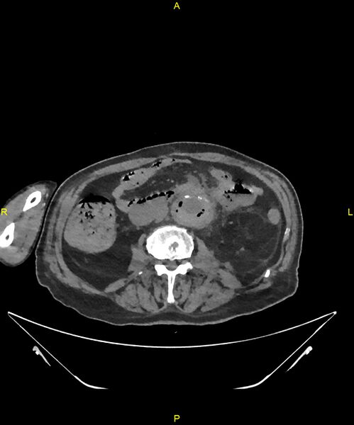 File:Aortoenteric fistula (Radiopaedia 84308-99603 Axial non-contrast 185).jpg