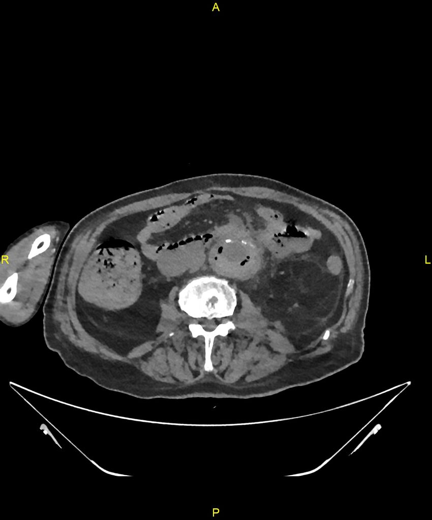 Aortoenteric fistula (Radiopaedia 84308-99603 Axial non-contrast 185).jpg