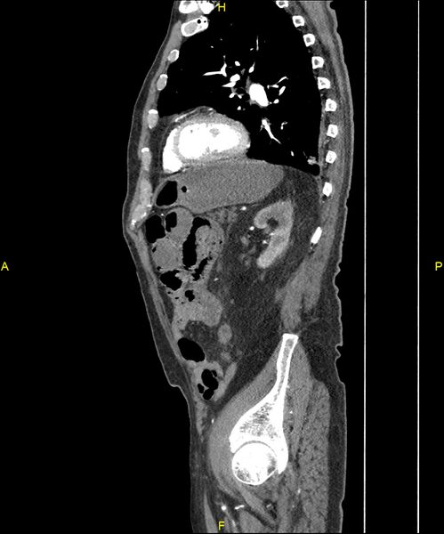 File:Aortoenteric fistula (Radiopaedia 84308-99603 C 243).jpg