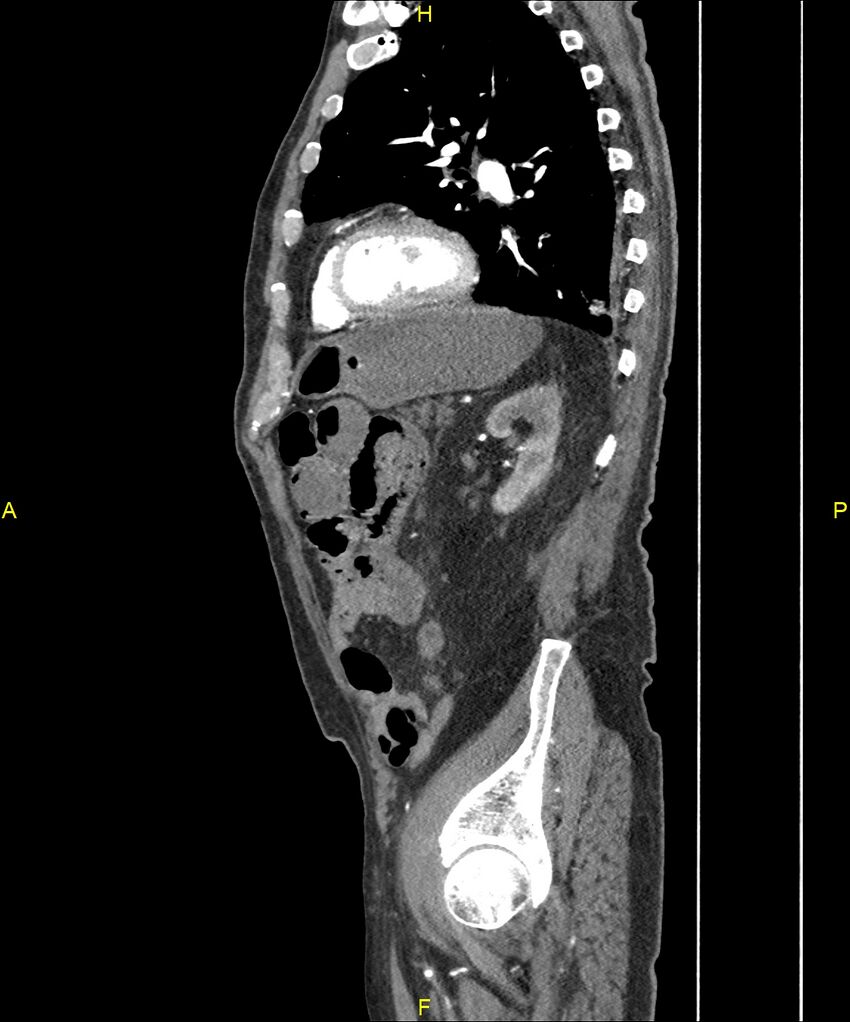 Aortoenteric fistula (Radiopaedia 84308-99603 C 243).jpg