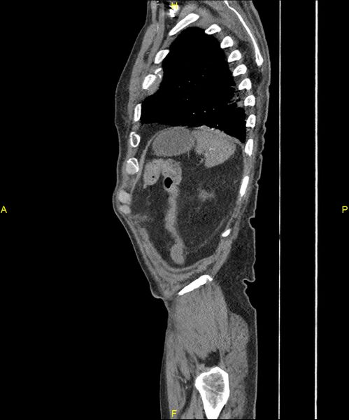 File:Aortoenteric fistula (Radiopaedia 84308-99603 C 295).jpg