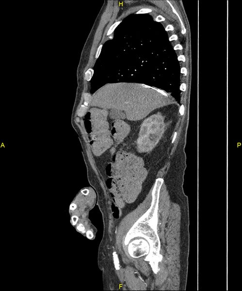 File:Aortoenteric fistula (Radiopaedia 84308-99603 C 87).jpg