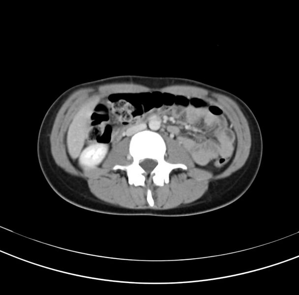 File:Appendicitis and incidental bicornuate uterus (Radiopaedia 22833-22853 B 21).jpg