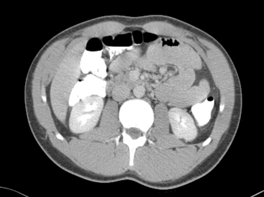 Appendicitis and incidental foregut duplication cyst (Radiopaedia 52962-58916 A 24).jpg
