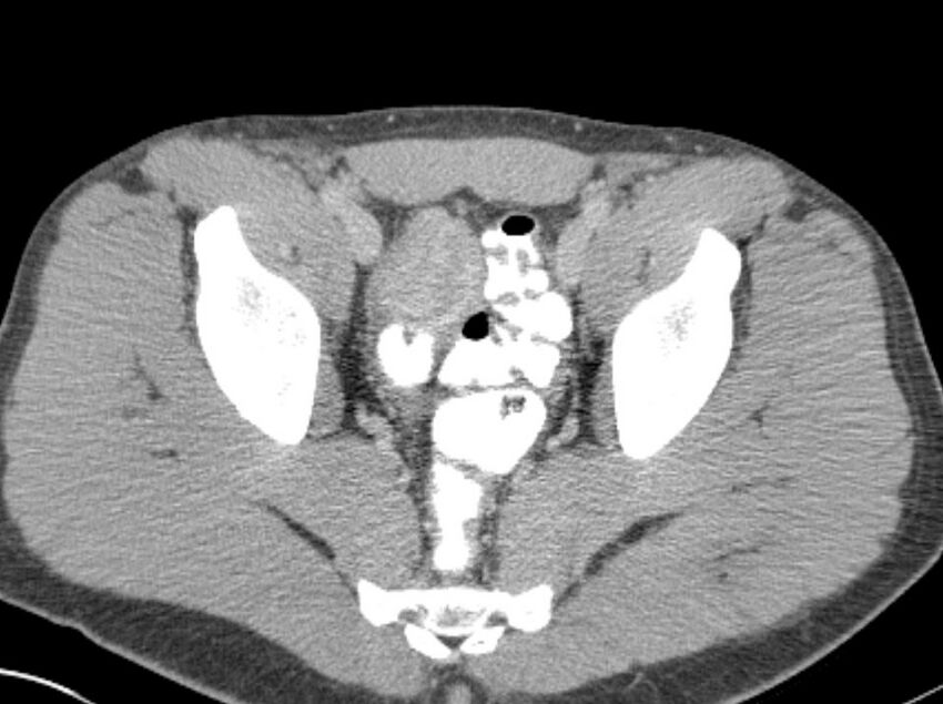 Appendicitis and incidental foregut duplication cyst (Radiopaedia 52962-58916 A 89).jpg