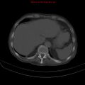 Arachnoiditis ossificans (Radiopaedia 51394-57136 Axial bone window 4).jpg