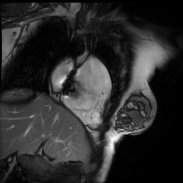 File:Arrhythmogenic right ventricular cardiomyopathy (Radiopaedia 87505-103850 2ch (RV) Cine SSFP 78).jpg