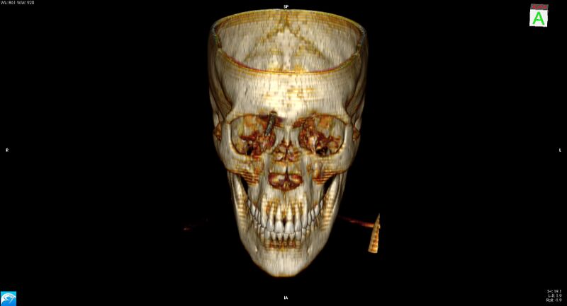 File:Arrow injury to the brain (Radiopaedia 72101-82607 3D bone 6).jpg