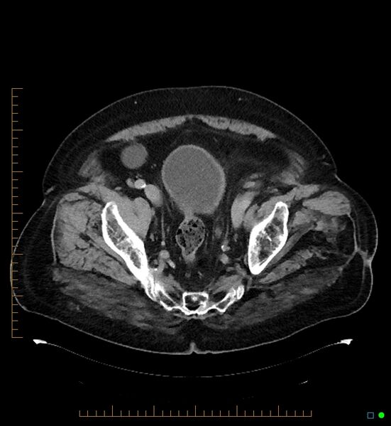File:Artificial urethral sphincter (Radiopaedia 46937-51464 A 2).jpg