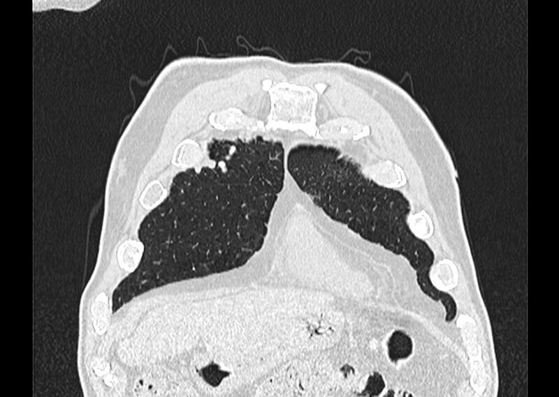 File:Asbestos pleural placques (Radiopaedia 57905-64872 Coronal lung window 28).jpg