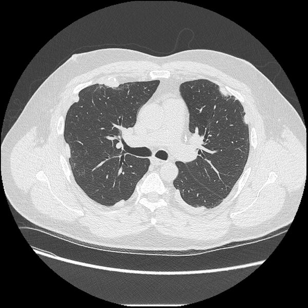 File:Asbestosis (Radiopaedia 45002-48961 Axial lung window 21).jpg