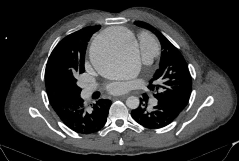 File:Ascending aortic aneurysm (Radiopaedia 86279-102297 C 28).jpg