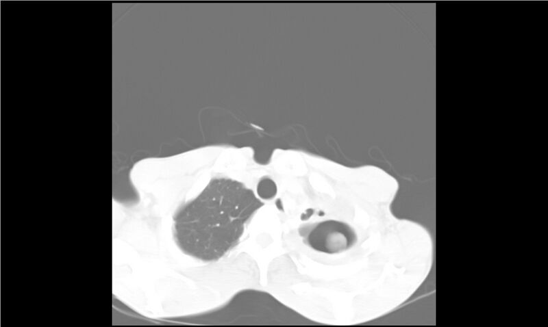 File:Aspergilloma (Radiopaedia 20788-20701 Axial lung window 5).jpg