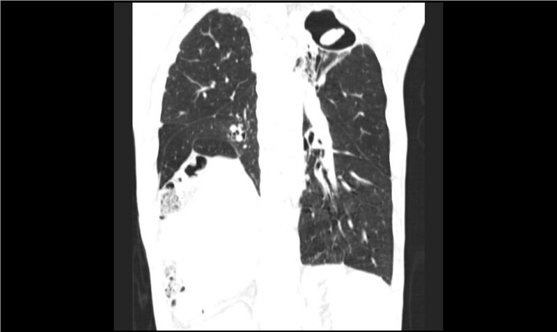 File:Aspergilloma (Radiopaedia 20788-20701 Coronal lung window 12).jpg
