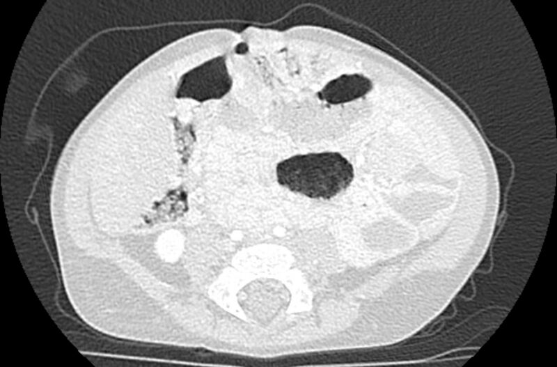 File:Asplenia syndrome (Radiopaedia 73083-83792 Axial lung window 111).jpg