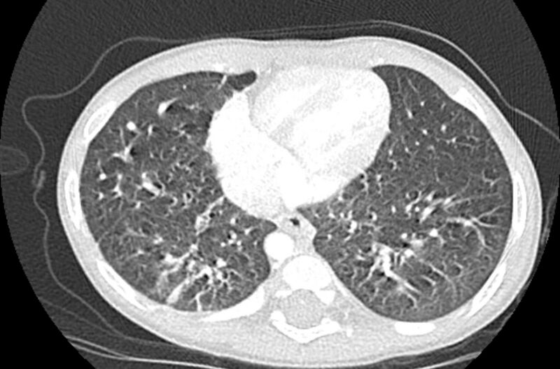 File:Asplenia syndrome (Radiopaedia 73083-83792 Axial lung window 53).jpg