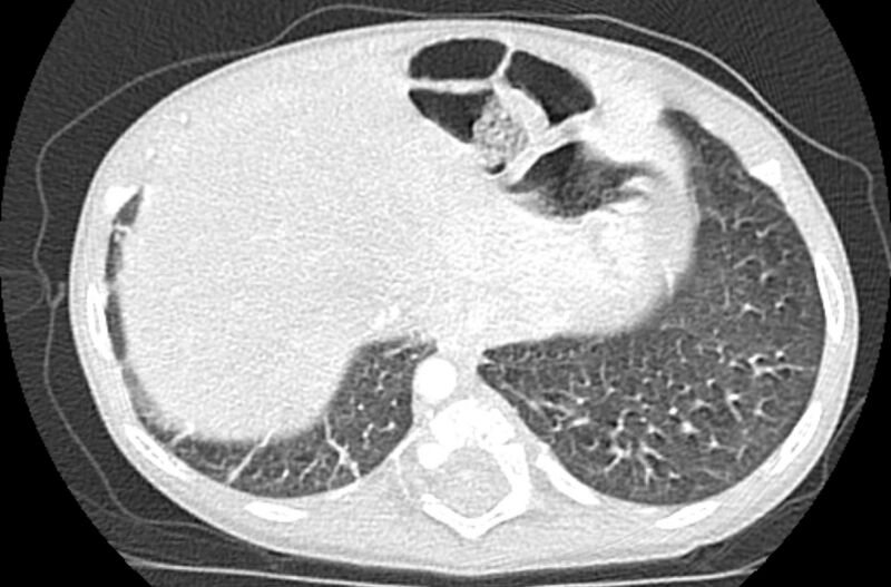 File:Asplenia syndrome (Radiopaedia 73083-83792 Axial lung window 65).jpg