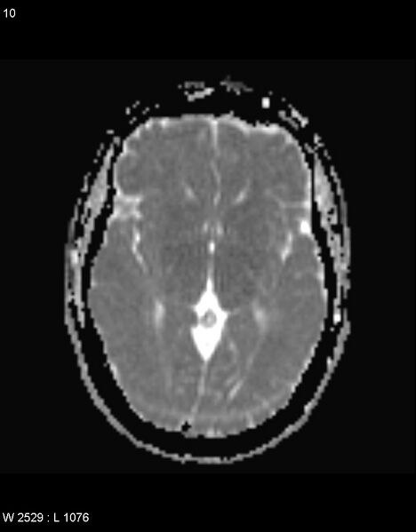 File:Astroblastoma (Radiopaedia 39792-42217 Axial ADC 9).jpg