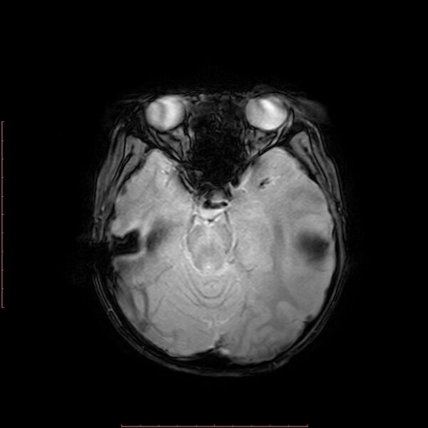 File:Astroblastoma (Radiopaedia 74287-85162 Axial SWI 7).jpg