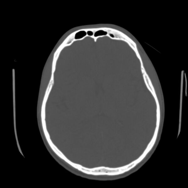 File:Asymptomatic occipital spur (Radiopaedia 87753-104201 Axial bone window 108).jpg