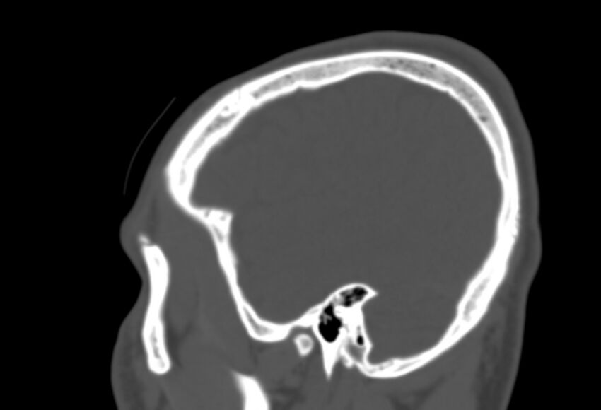 Asymptomatic occipital spur (Radiopaedia 87753-104201 Sagittal bone window 260).jpg