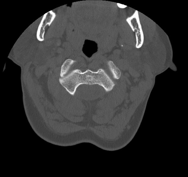 File:Atlanto-occipital assimilation with basilar invagination (Radiopaedia 70122-80188 Axial bone window 32).jpg