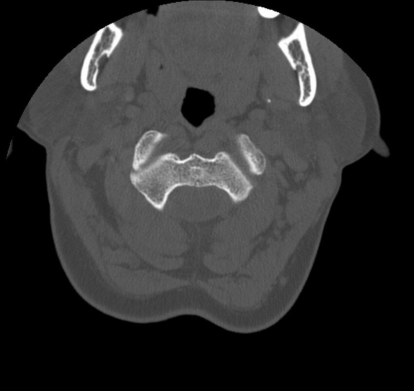 Atlanto-occipital assimilation with basilar invagination (Radiopaedia 70122-80188 Axial bone window 32).jpg