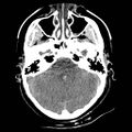 Atlanto-occipital dislocation (Radiopaedia 44648-48412 Axial non-contrast 16).jpg