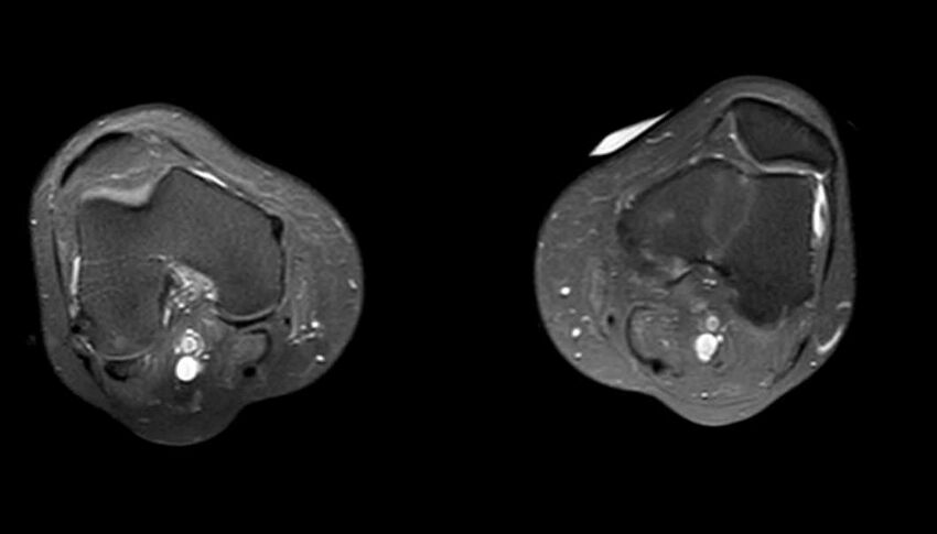 Atypical lipomatous tumor - thigh (Radiopaedia 68975-78734 Axial PD fat sat 11).jpg
