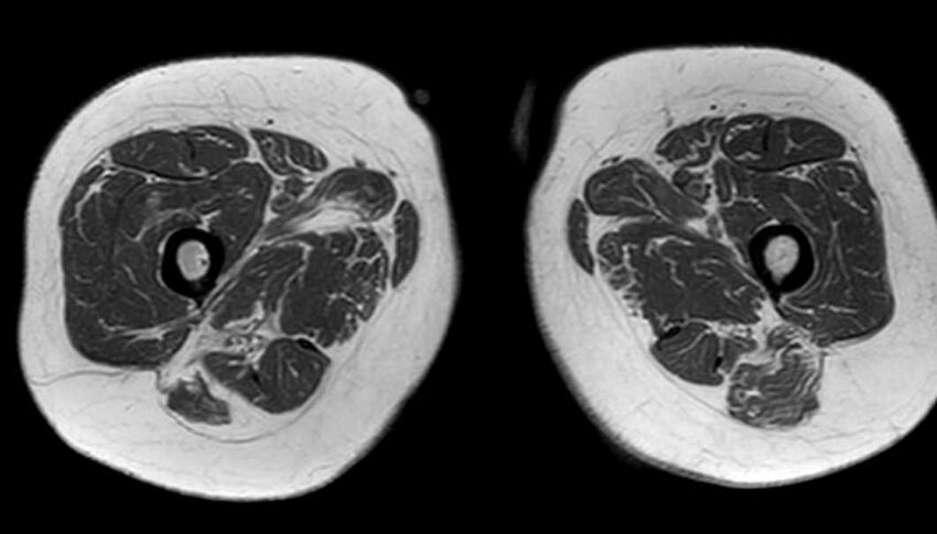 Atypical lipomatous tumor - thigh (Radiopaedia 68975-78734 Axial T1 66).jpg