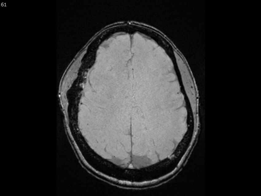Atypical meningioma - intraosseous (Radiopaedia 64915-74572 Axial SWI 61).jpg
