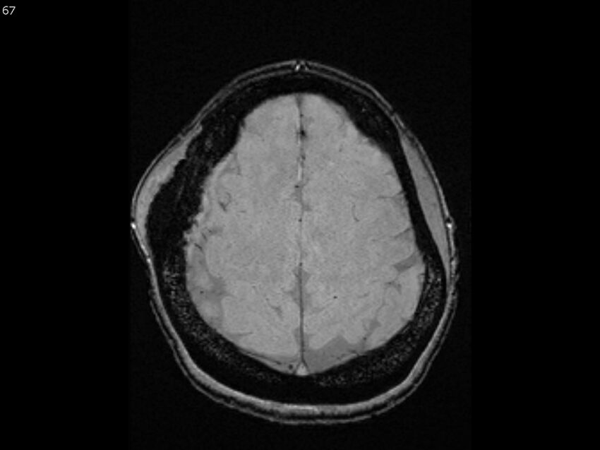 Atypical meningioma - intraosseous (Radiopaedia 64915-74572 Axial SWI 67).jpg