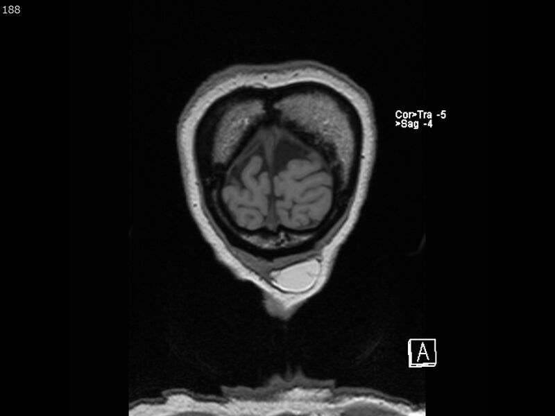 File:Atypical meningioma - intraosseous (Radiopaedia 64915-74572 Coronal T1 188).jpg