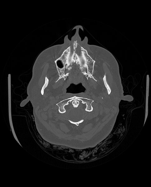 File:Automastoidectomy with labyrinthine fistula (Radiopaedia 84143-99411 Axial non-contrast 41).jpg