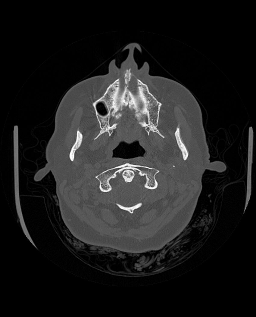 Automastoidectomy with labyrinthine fistula (Radiopaedia 84143-99411 Axial non-contrast 41).jpg