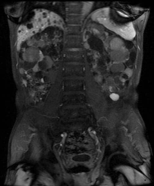 File:Autosomal dominant polycystic kidney disease (Radiopaedia 11220-11585 Coronal 2).jpg